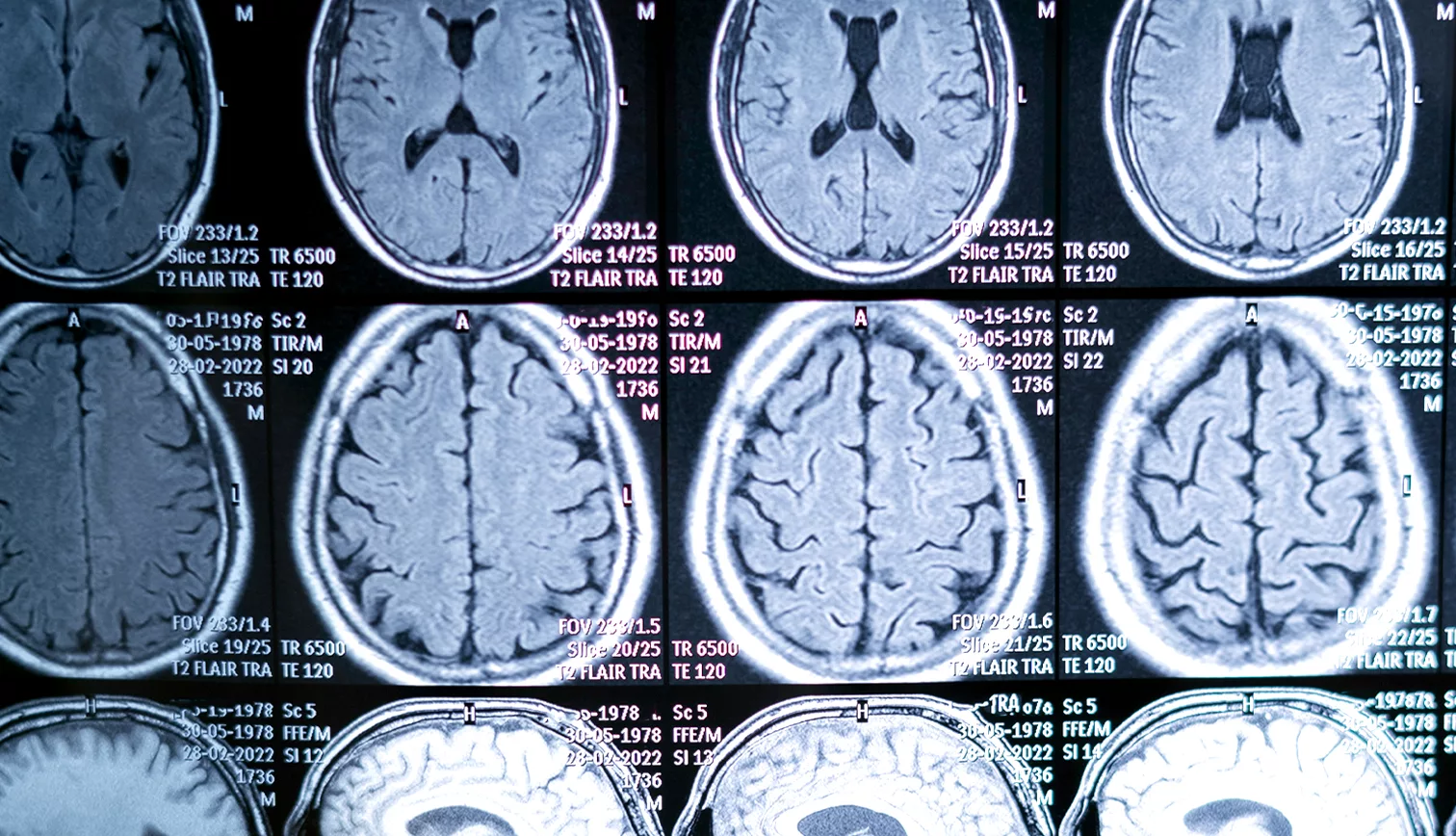 Moždani Udar Poliklinika Rehapro